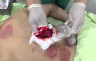 Episode 539 P365: Hijama (bloodletting) Wet Cupping